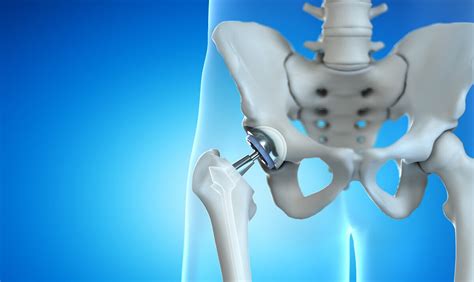 anterior hip replacement doctors.